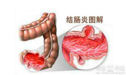 结肠炎危害大,及时检查和治疗!